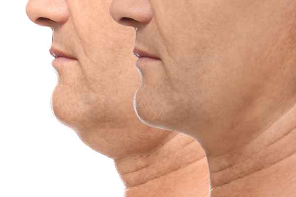 HIFU - Breakthrough in Anti - ageing 2 hifu results Scottish