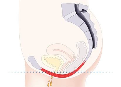Pelvic-Floor Muscle Repair 5 Pelvic floor muscles Scottish