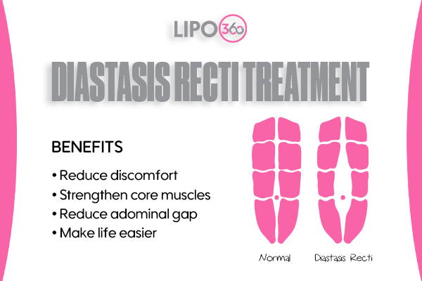 Revolutionising Muscle Repair: The Power of LIPO360 Body Sculpt Post-Injury 5 diastasis recti treatment Scottish