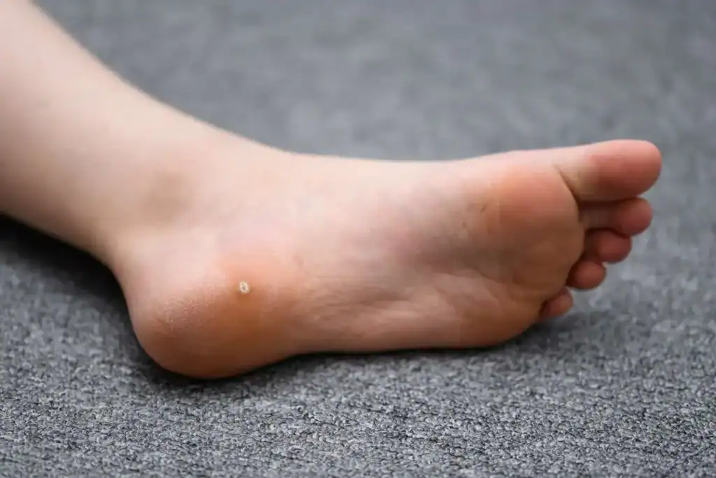 Cryotherapy For Warts And Also Verrucas 2 Image of verruca on the bottom of the foot that able to be treated with Cryotherapy Scottish