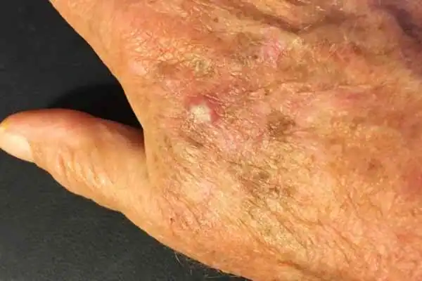 Cryopen For Actinic Keratoses 1 Image of Actinic keratoses Scottish on a person hand