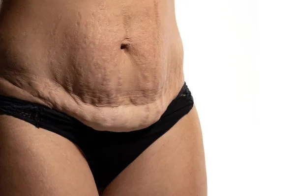 The Science of Skin Tightening 1 The science behind skin tightening Scottish picture of a woman's sagging skin on the stomach
